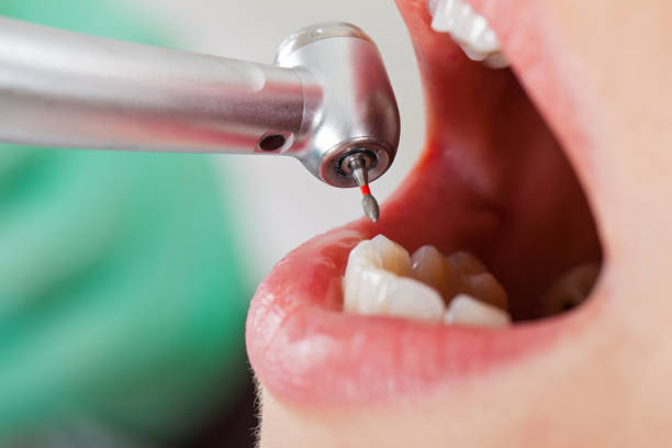 Best Emergency Root Canal Treatment in Florence, TX
